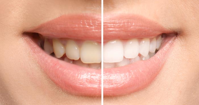 Teeth Whitening before and after